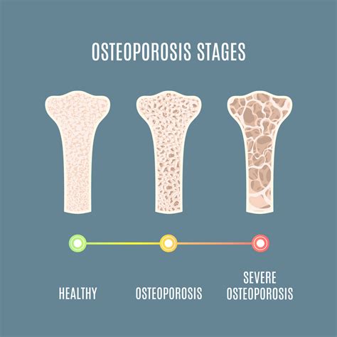 Increases Bone Density and Prevents Osteoporosis